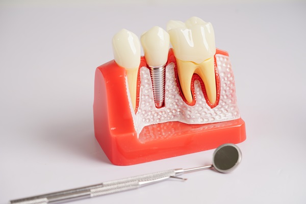 Dental Crown &#    ; When Does It Need To Be Repaired?