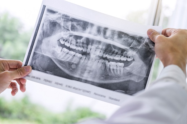 Recovering From A Dental Implant Placement Before Restoration
