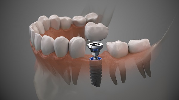 Who Is A Candidate For Dental Implants?