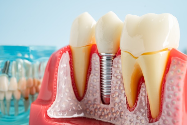 When Dental Implants Are The Ideal Teeth Replacement Option