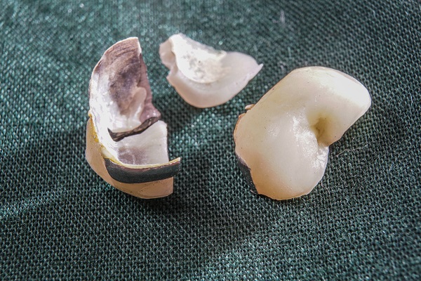 A Dental Veneer &#    ; Solution For A Broken Tooth
