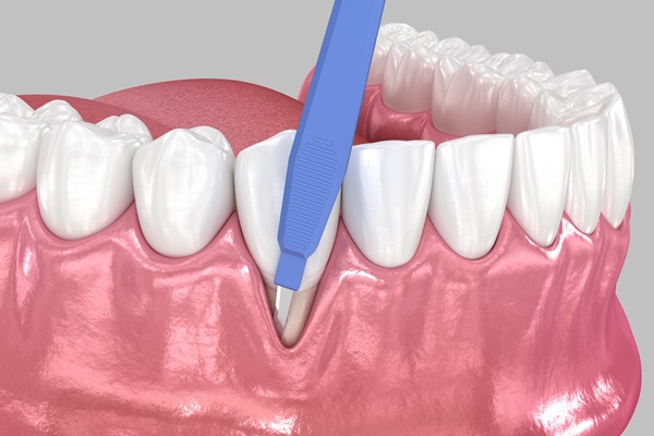 Gingivitis To Periodontitis: The Stages Of Gum Disease